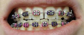 Dental braces and orthodontic treatment in Kishangarh