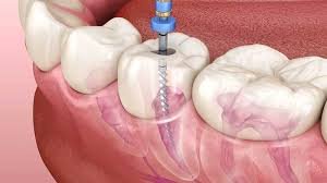 Root canal treatment in Kishangarh at JP Dental Hospital